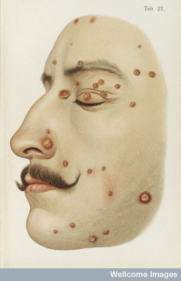 L0038203 Illustration of face diseased with Syphilis