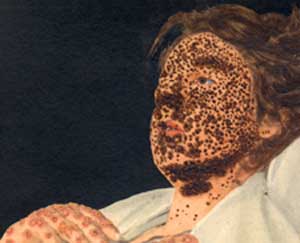 smallpox victims