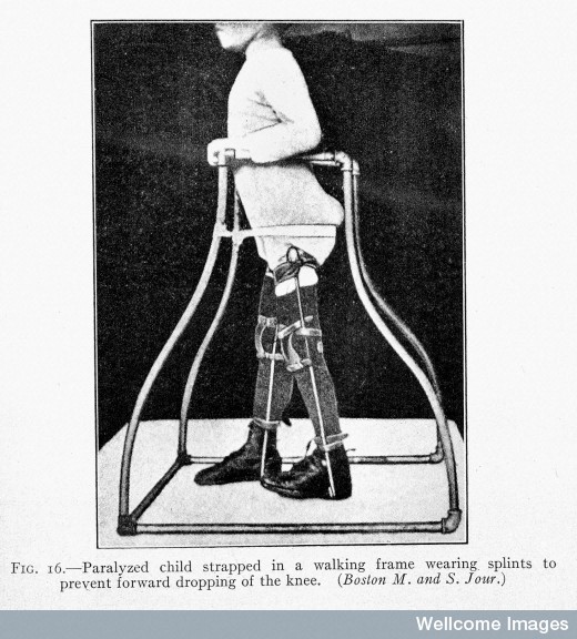 R.W.Lovett, Treatment of Infantile Paralysis